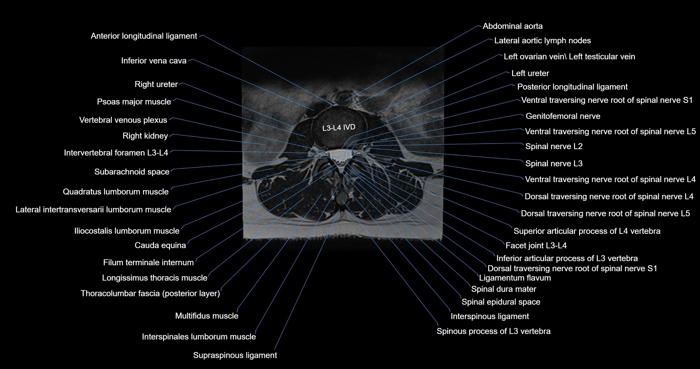 MRI lumbar spine axial cross sectional anatomy 3T radiology  image-img-00001-00027.webp